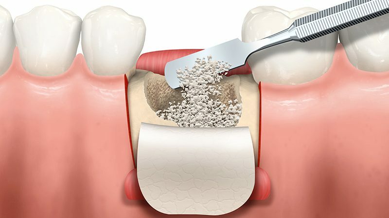 Dentista in Albania, Impianti dentali, protesi dentale fissa e mobile, corone e faccette dentali